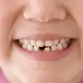 The 7-Year-Old Indian Girl with 202 Teeth