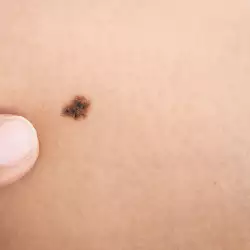 What Do Moles on the Belly Mean?