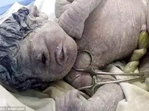 Newborn with a Single Eye Proves That Cyclopes Did Exist