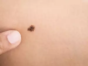 What Do Moles on the Belly Mean?