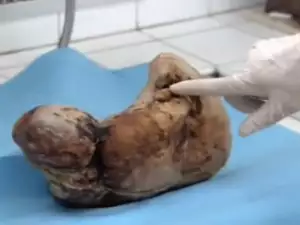 Old Chinese Woman Gives Birth to Stone Baby