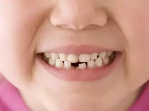 The 7-Year-Old Indian Girl with 202 Teeth