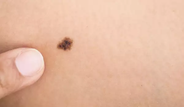 What Do Moles on the Belly Mean?